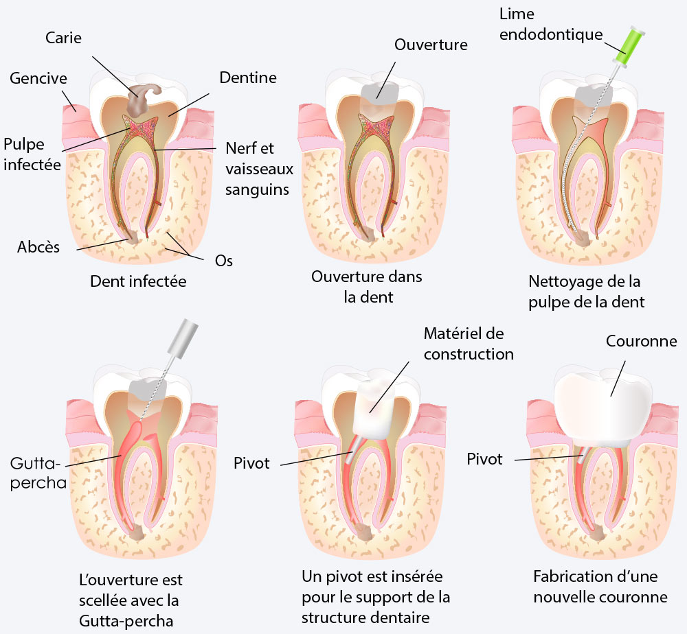 Endodontie - Traitement Canalaire
